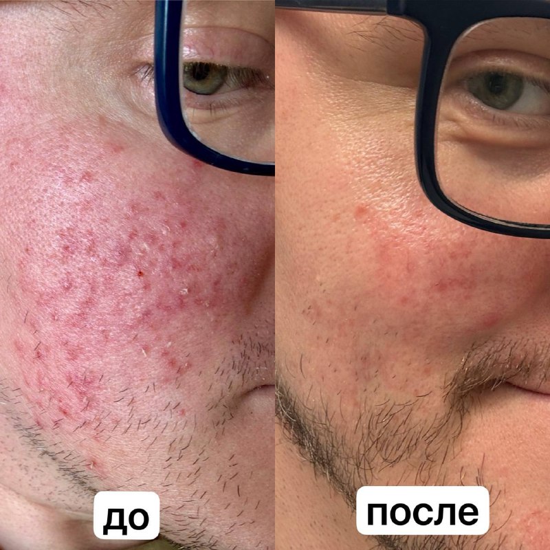 ЧатГПТ вылечил мне Розацею, а дерматологи нет